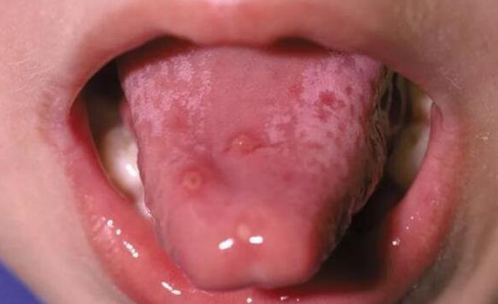 口腔粘膜炎的症状图片图片