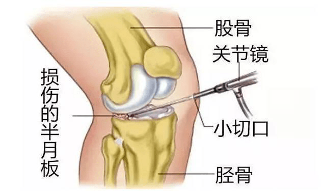 就算没受伤,也可能撕裂,损伤的"盘状半月板"原来长这样……_膝关节