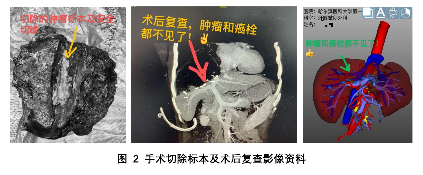 哈医大一院肝脏微创外科成功完成完全腹腔镜下门静脉切开取癌栓肝中叶