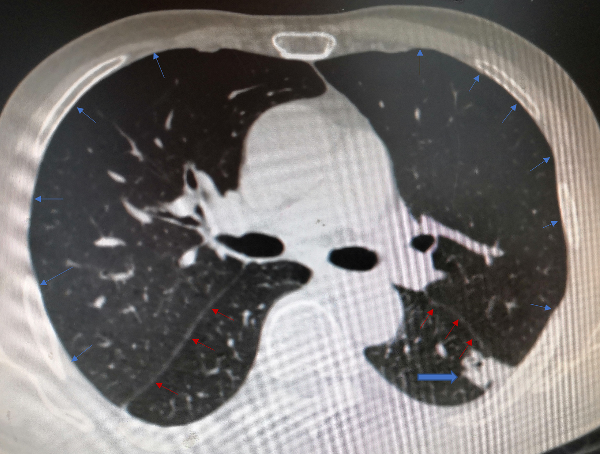 肺结节位于胸膜下更加危险吗,更容易转移吗?需要积极手术吗?