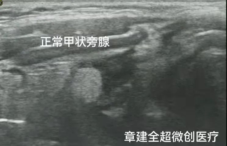 正常甲状旁腺超声图片图片