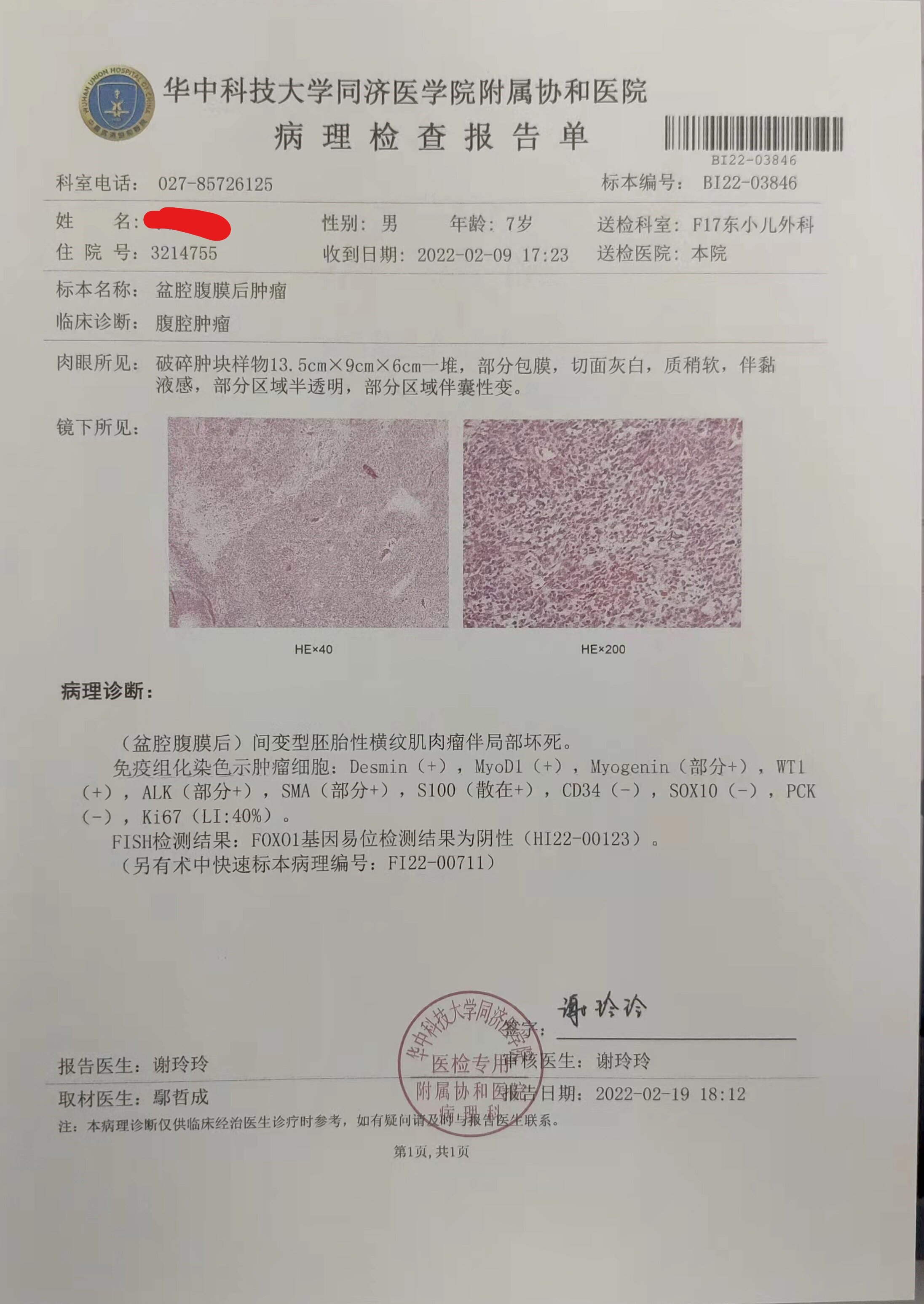 间变型胚胎性横纹肌肉瘤1例(7岁8月男孩)报告并文献复习-来自湖北宜昌