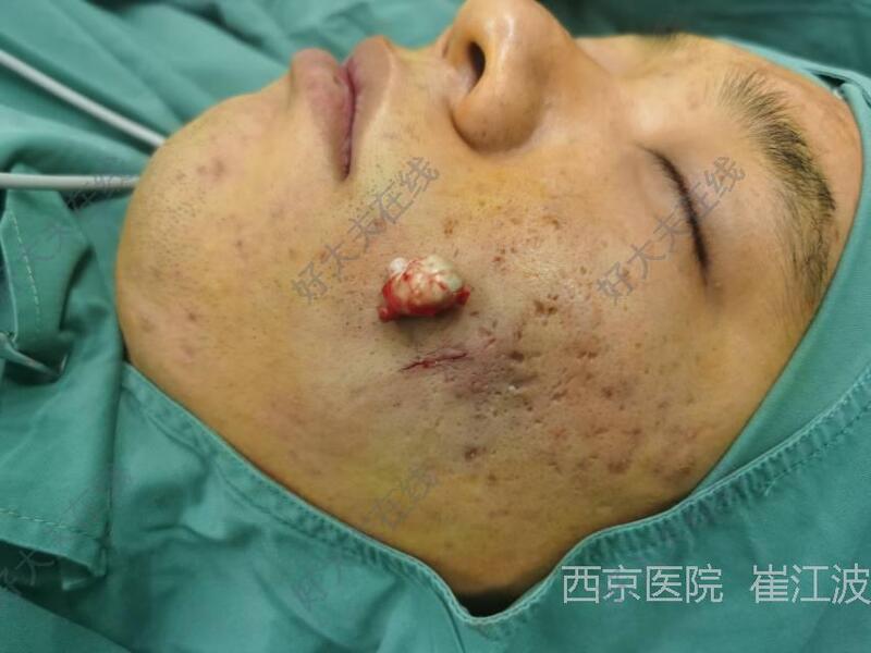 脸部皮脂腺囊肿手术图片