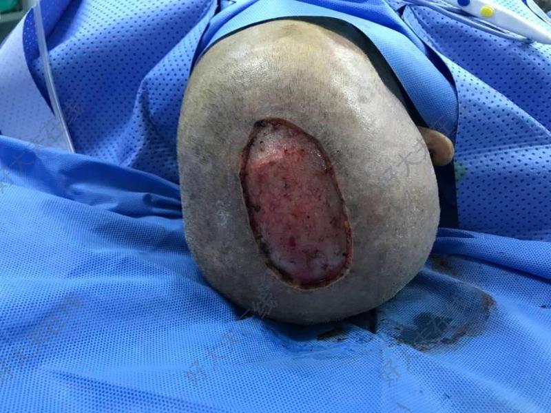 鳞癌切除植皮术