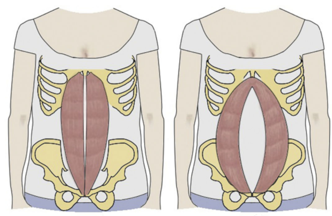 在產後一部分女性腹直肌