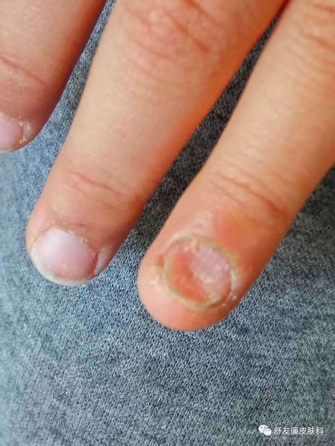 小孩子指甲抠来抠去会变形