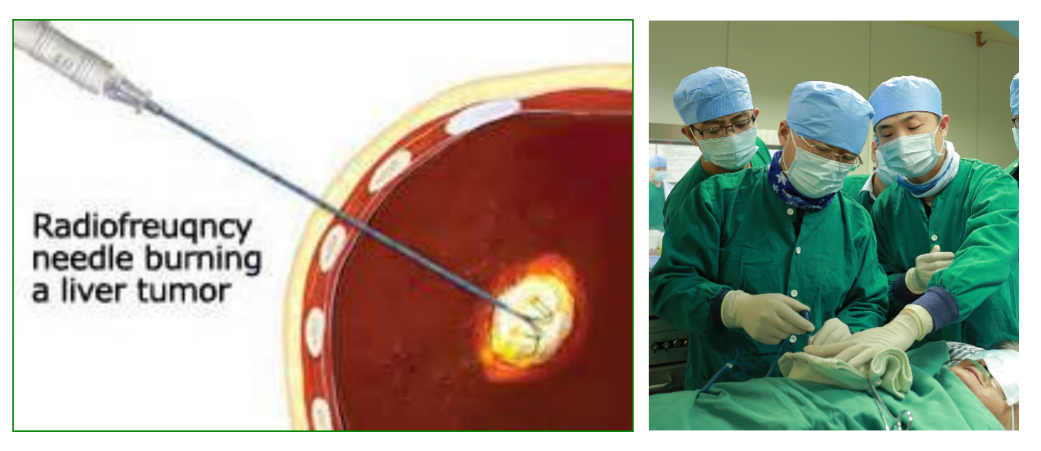 早期肝细胞肝癌:消融治疗是否是最佳选择之一?_肝癌 - 好大夫在线
