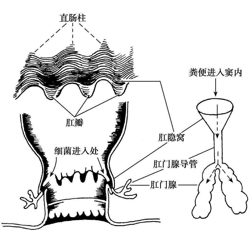 图1:肛腺解剖结构脓肿一旦形成应及时给予手术治疗