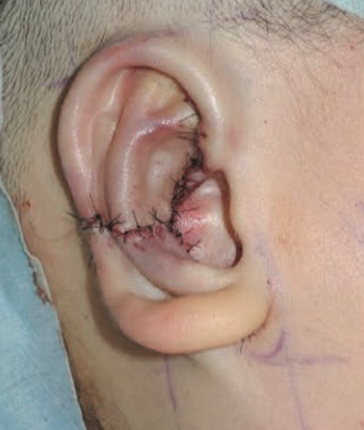 【耳再造案例分享】为爱圆梦,给耳朵一次新生! - 好大夫在线