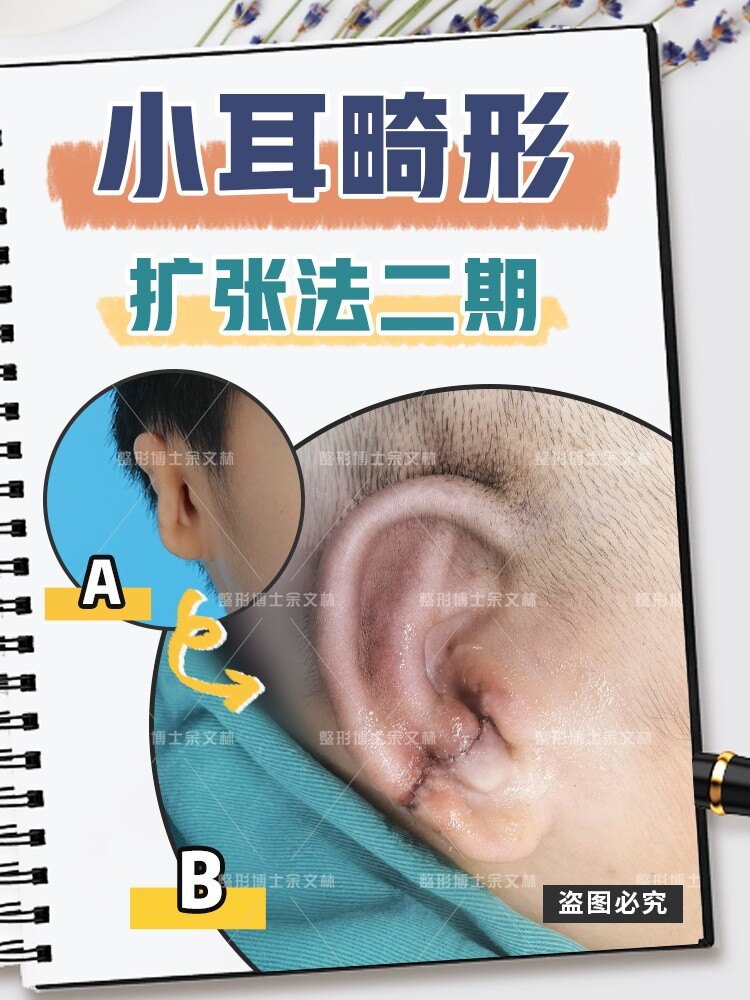案例故事做完耳再造手术二期了终于可以摆脱自卑感