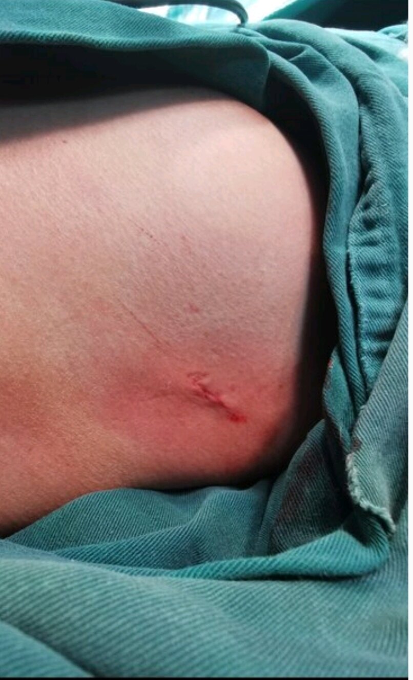 (三)手汗症手术十大疑问详解(下篇)(周晓医生手汗症治疗团队) - 好