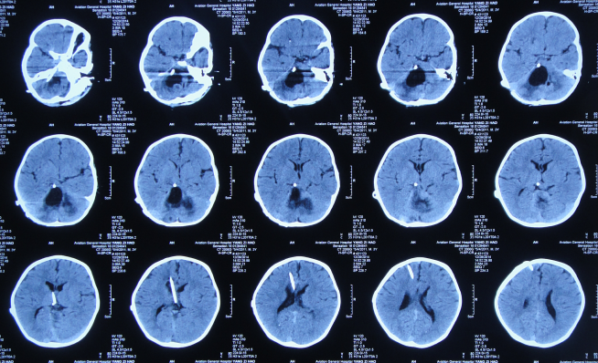术及囊肿外引流管调整术,术中见有四脑室周围粘连及脓性分泌物流出