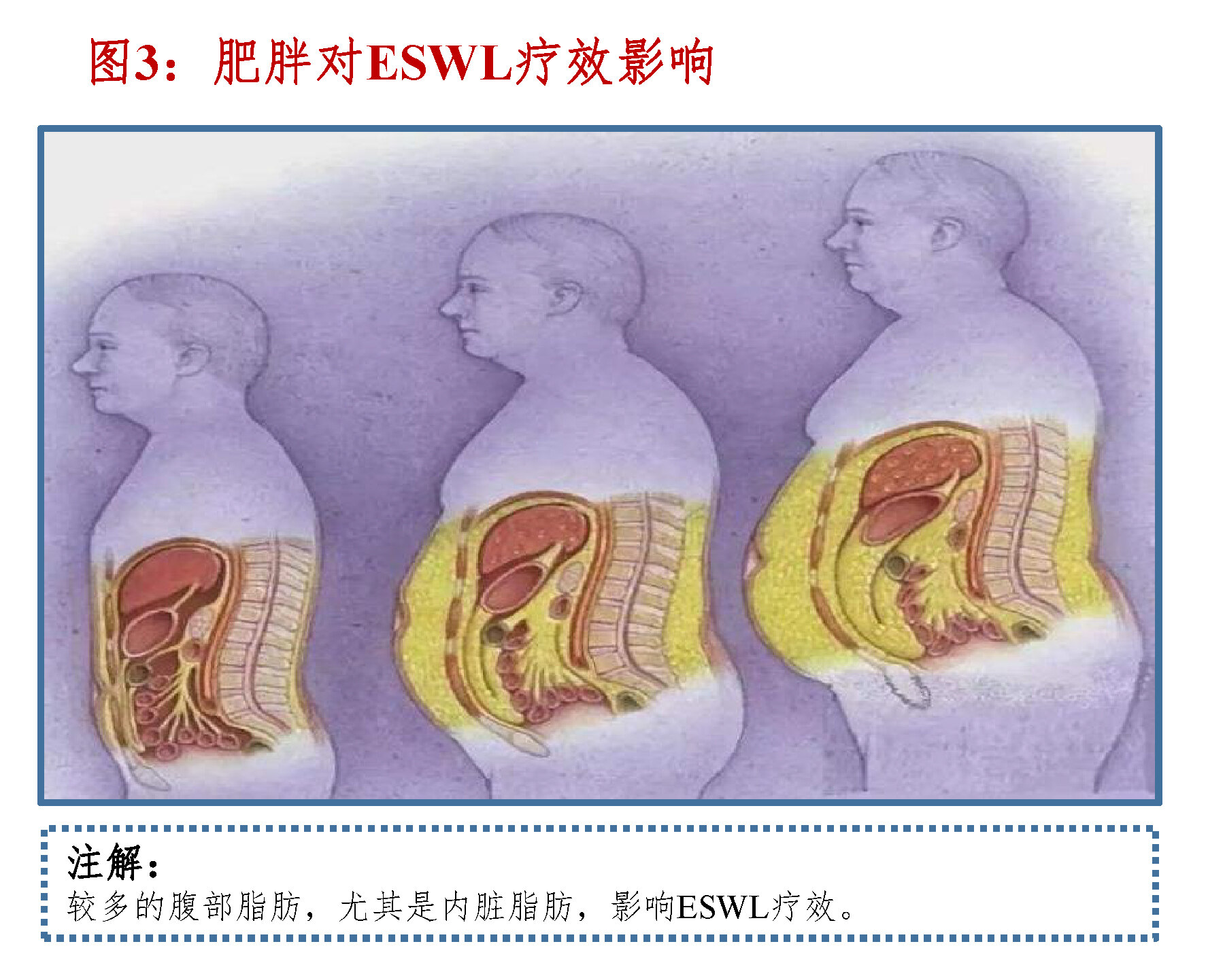 图3：肥胖对ESWL疗效影响.jpg