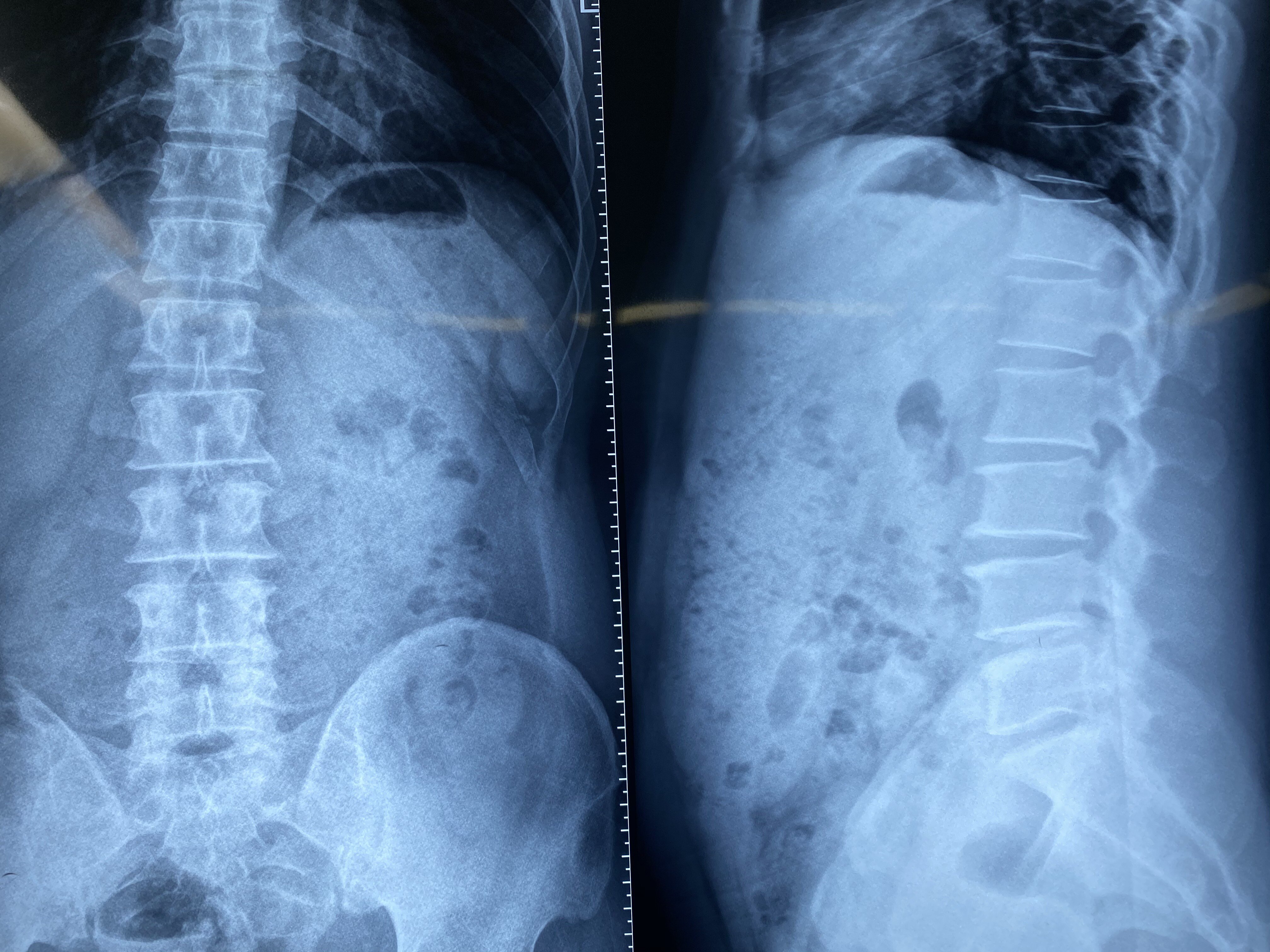 椎管狭窄的ct图片图片