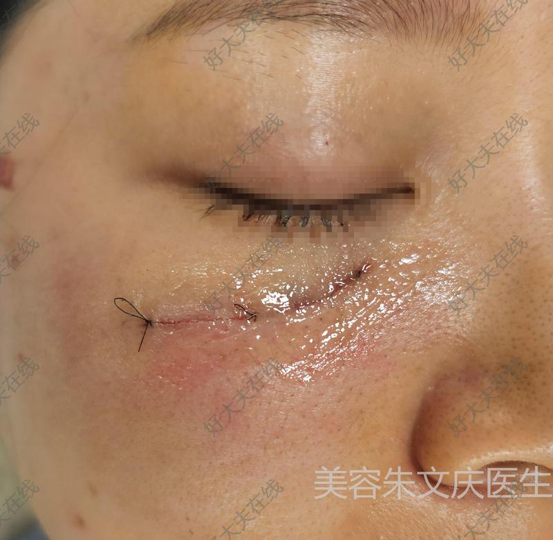 凹陷且增宽明显,要求改善,建议手术切除和美容缝合