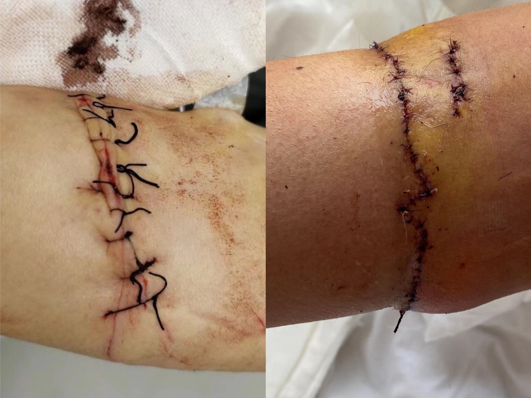 美容缝合后的瘢痕再干预治疗_疤痕_疤痕治疗方式 - 好大夫在线