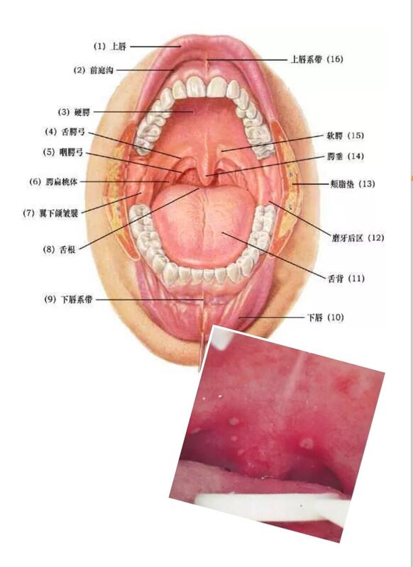 小儿疱疹性咽峡炎过程图片