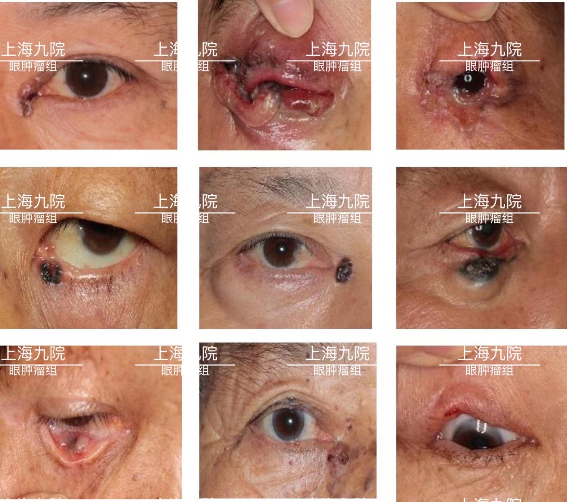 常见眼肿瘤类型及图谱