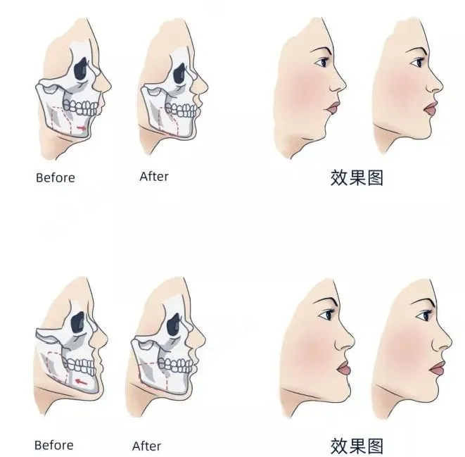 牙齿矫正对于颌骨发育及治疗的影响