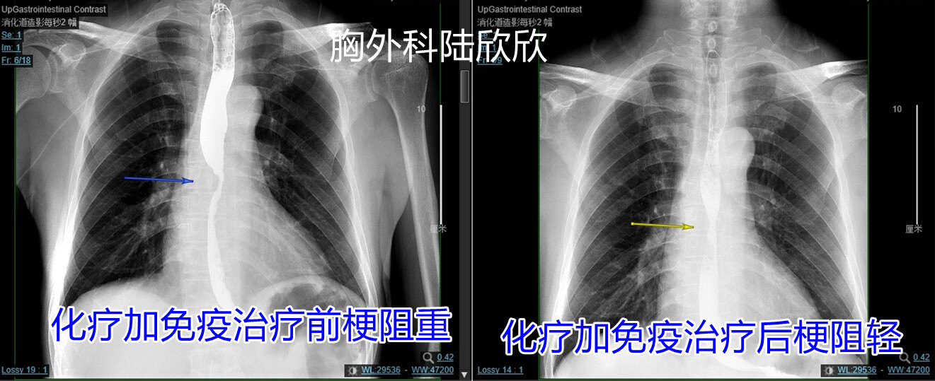 上消化道造影正面改善水印.jpg