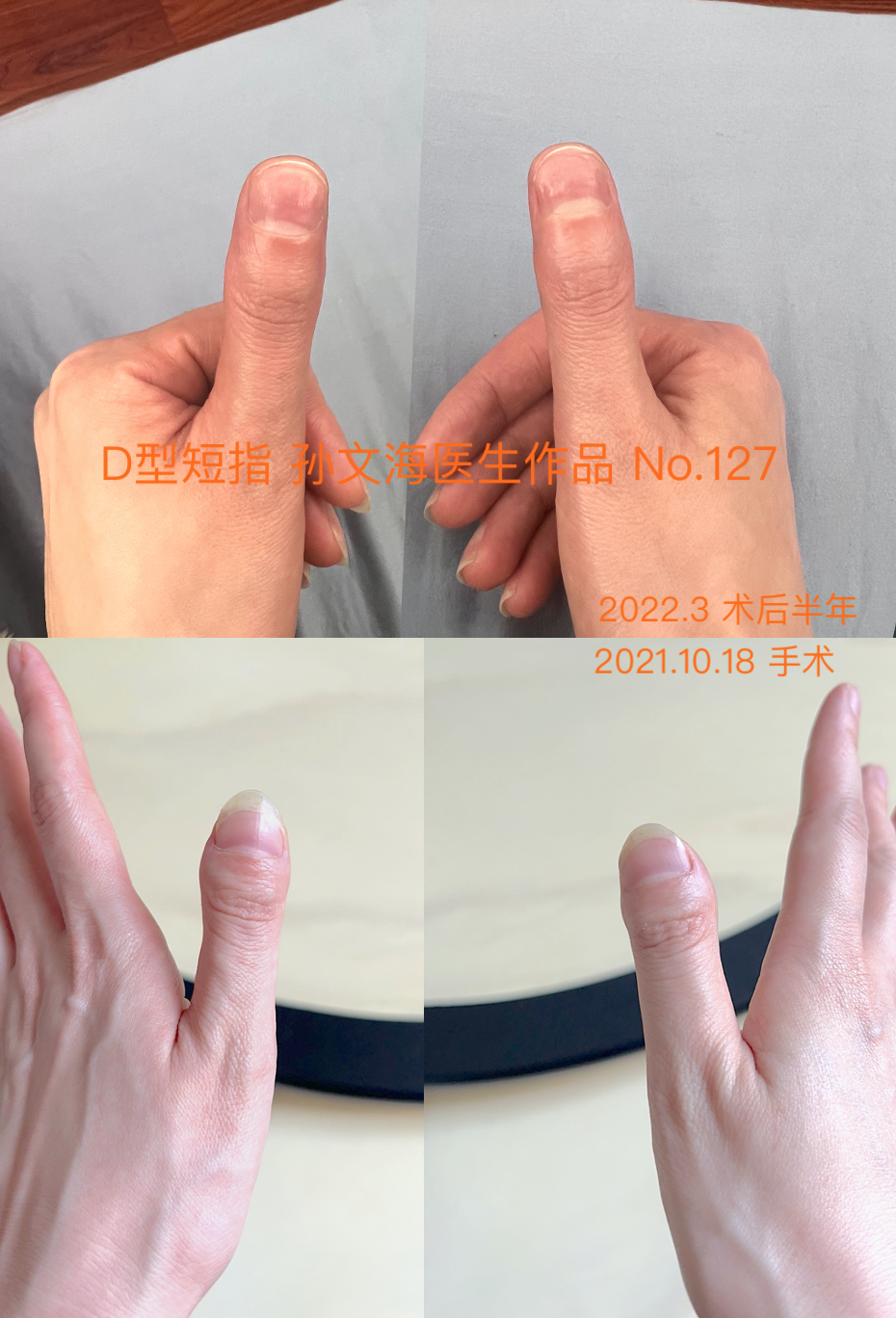 D型短指症的手术方法 附案例集 短指症 好大夫在线 D型短指症的手术方法 附案例集 短指症 好大夫在线