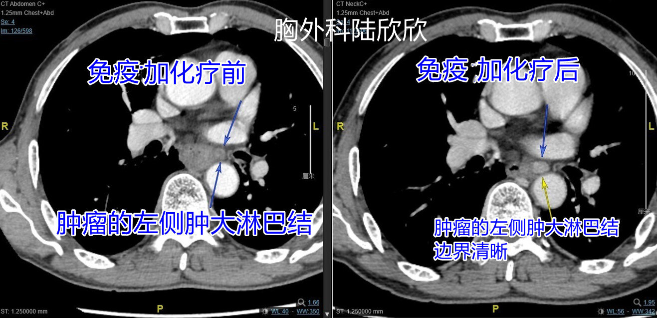 食管左侧淋巴结水印.jpg