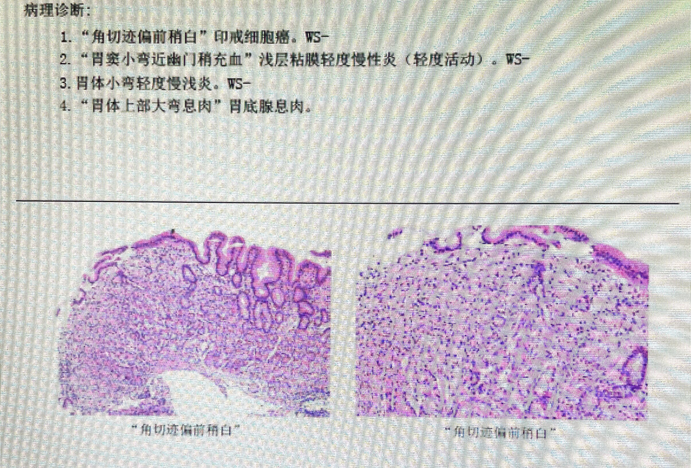 孙震胃镜1病理.jpg