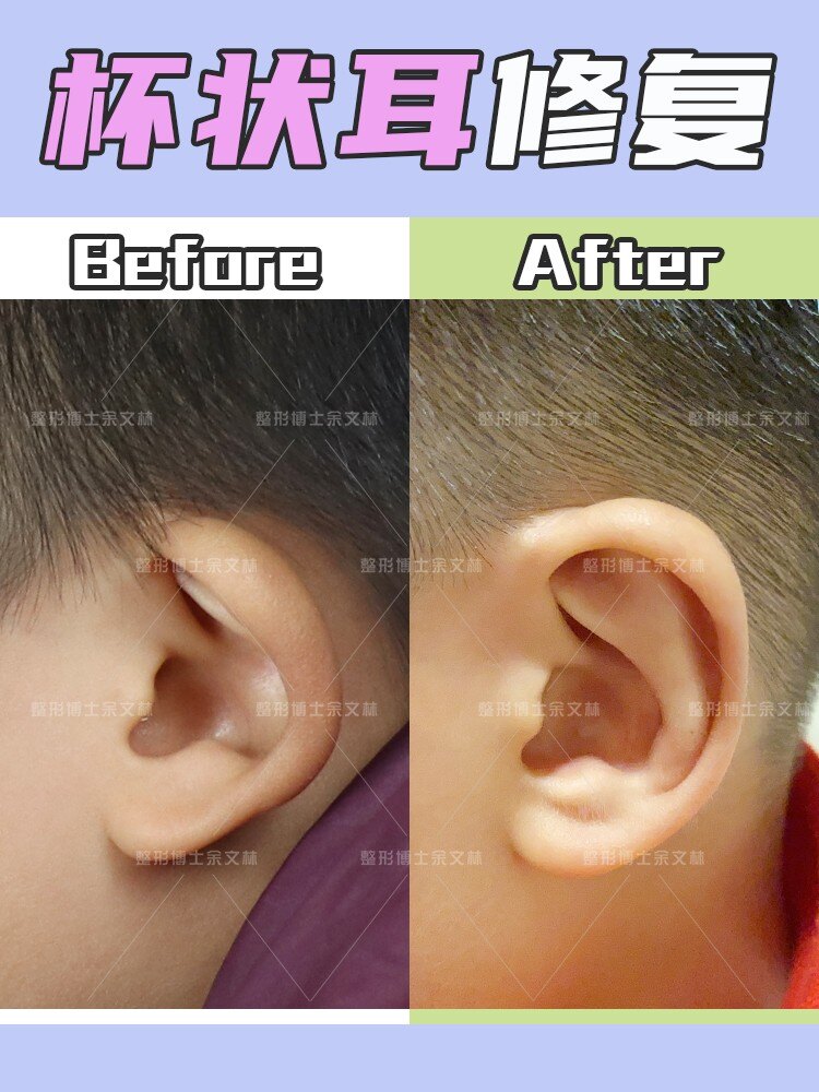 杯状耳杯状耳,又称为卷曲耳或垂耳为较常见的先天性耳畸形,多发生于