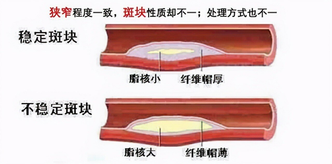 颈动脉有斑块,会有哪些症状?应该如何治疗?医生告诉你答案