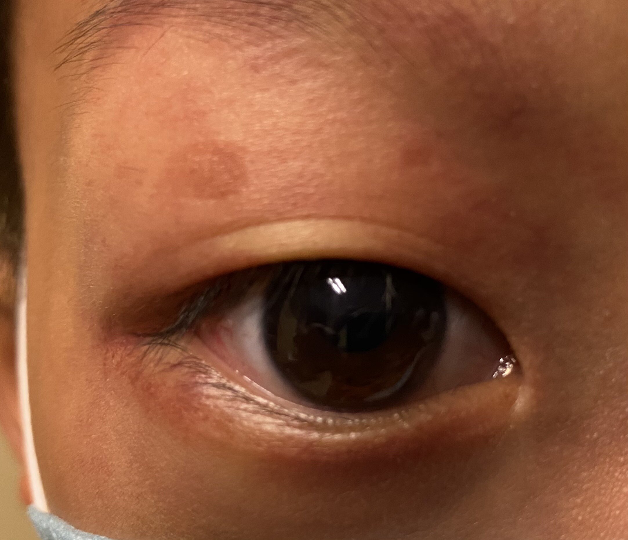 172倒睫系列之二小切口双重睑术治疗儿童上睑倒睫