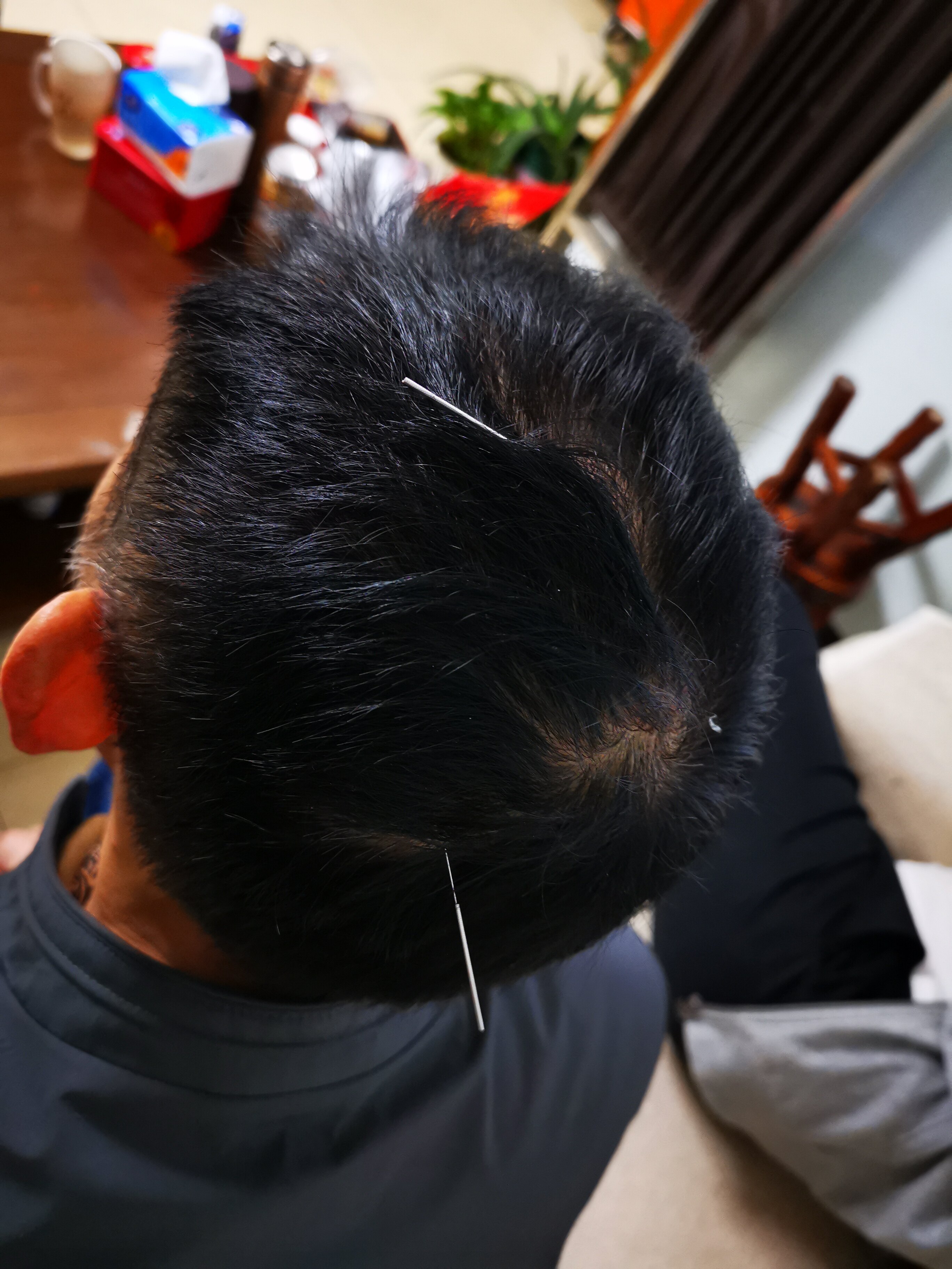 胃脘嘈杂不适,六气针法见神效 - 好大夫在线