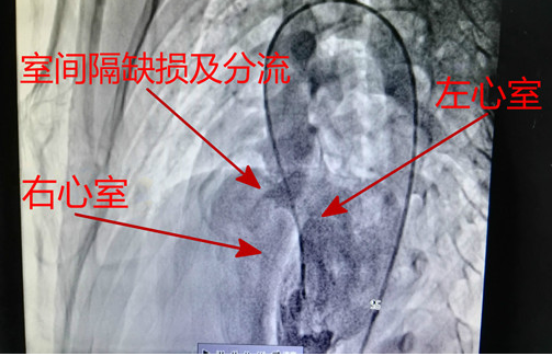 先心病—室间隔缺损_室间隔缺损_介绍_症状表现_治疗方式_日常注意事项 - 好大夫在线