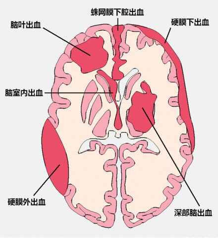 蛛網膜下腔出血(subarachnoid hemorrhage,sah)是出血性腦卒中的一個