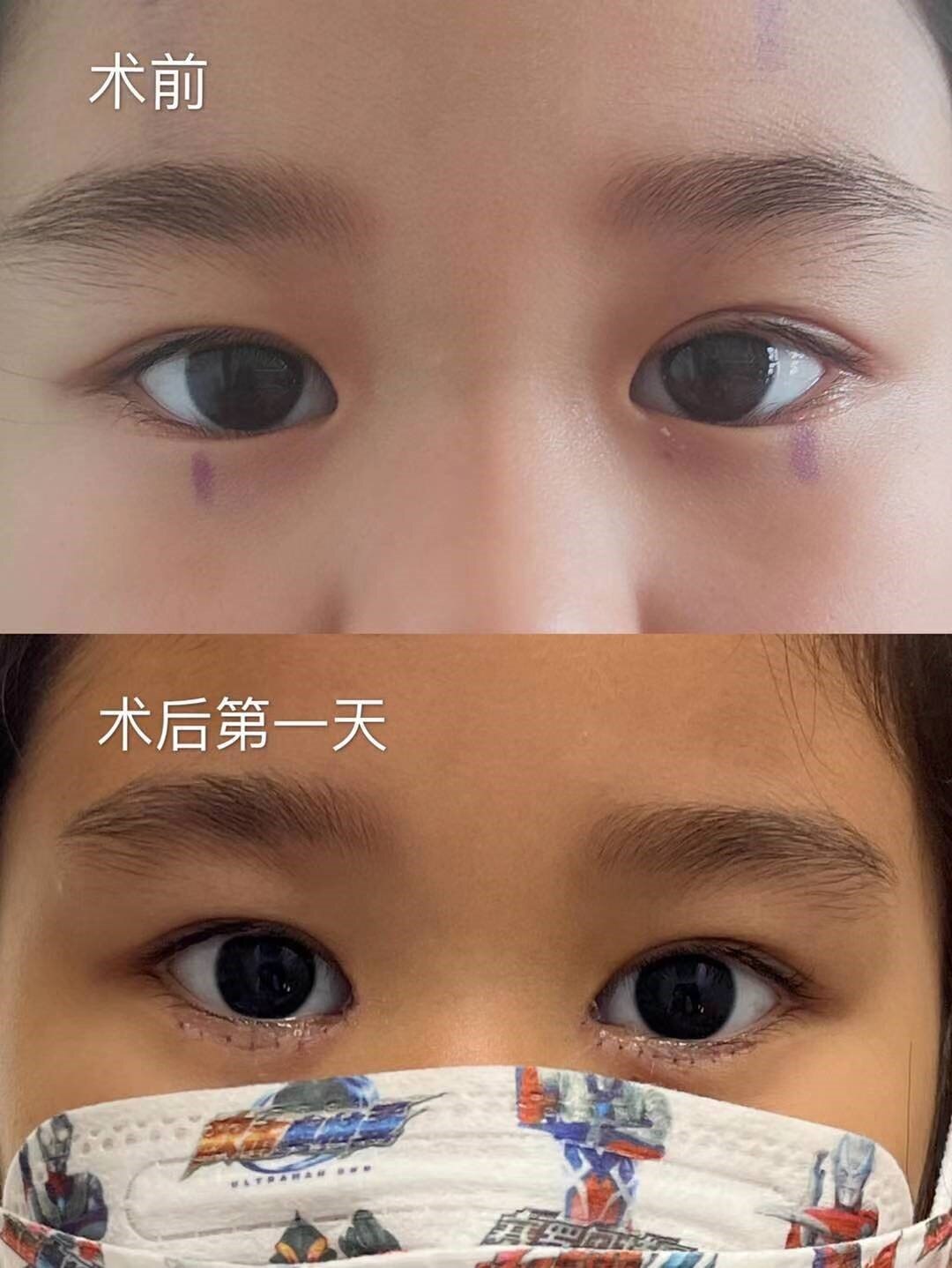 儿童倒睫手术图片