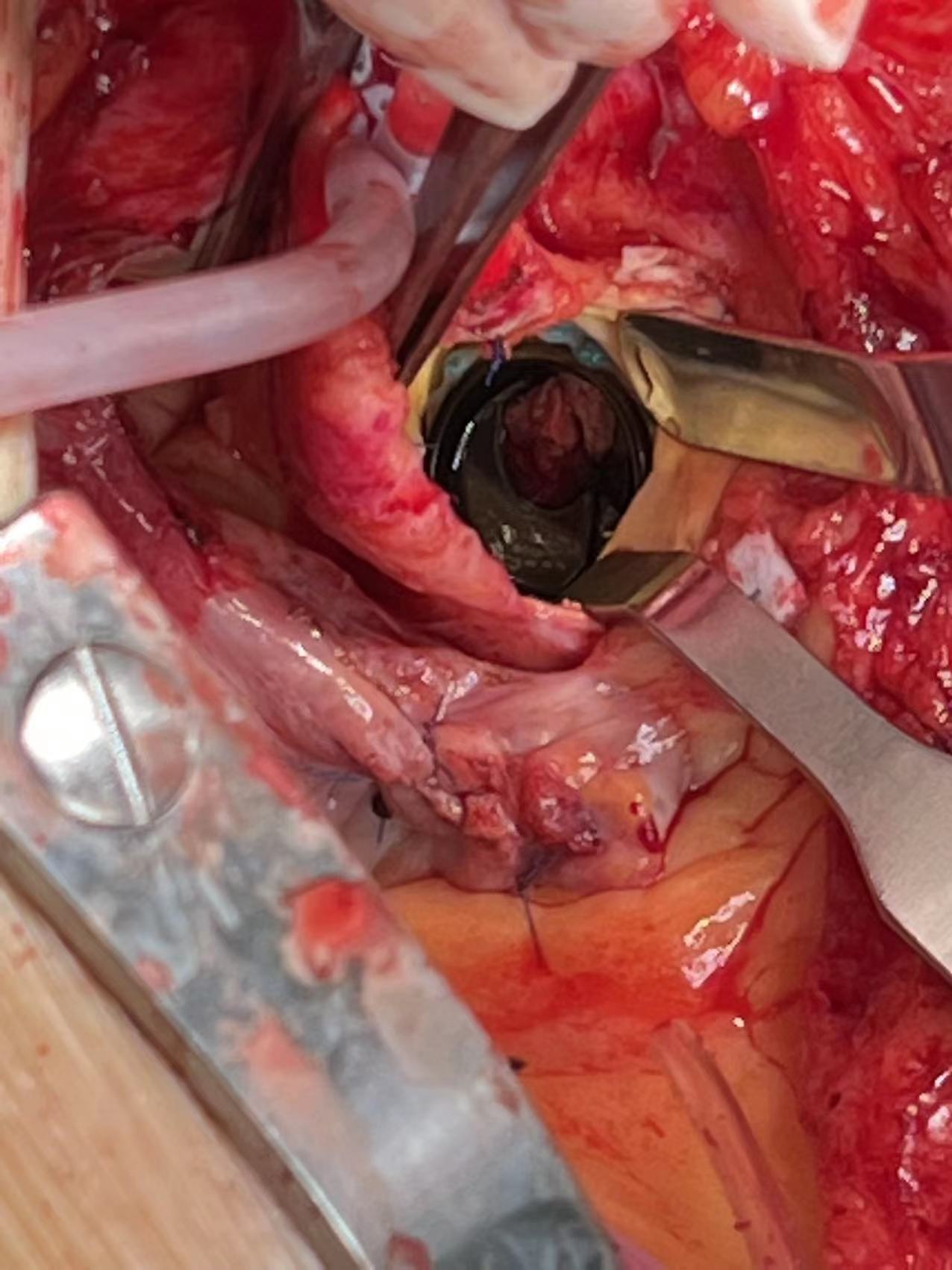 心脏瓣膜病的微创和危重手术_心脏瓣膜性疾病_心脏瓣膜性疾病治疗方式