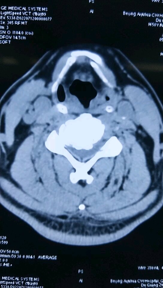 52岁脊髓型颈椎病单间隙微创手术 颈椎病 颈椎病治疗方式 好大夫在线