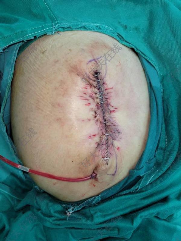 髋部褥疮_褥疮 - 好大夫在线