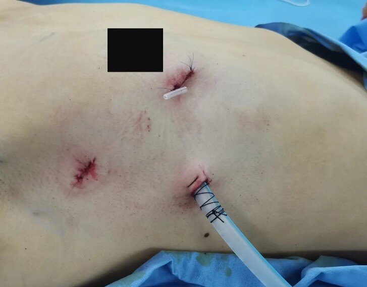 肺结节手术伤疤图片图片