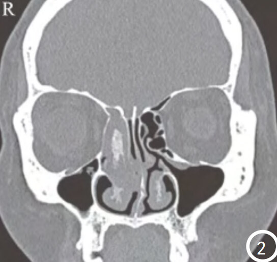 筛窦骨质增厚.jpg