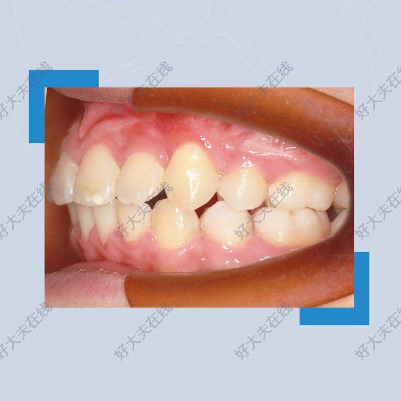 凸面型_正畸 - 好大夫在线