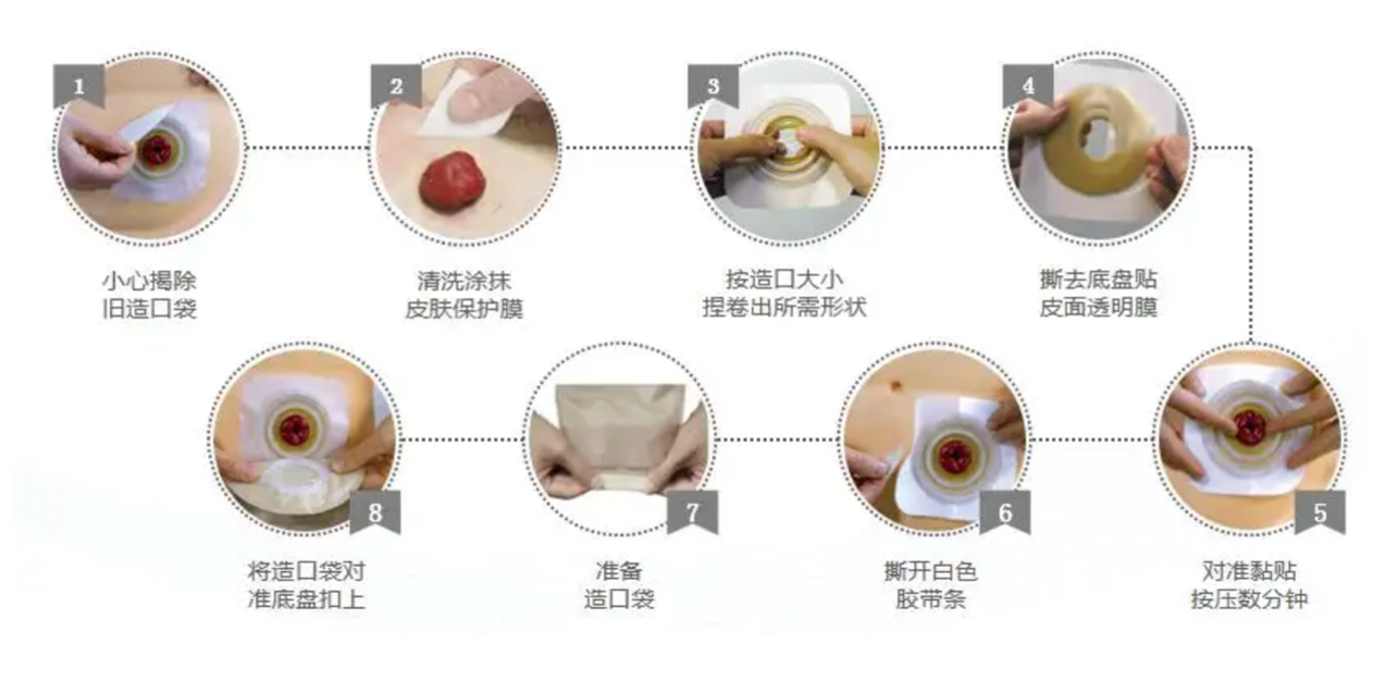 大肠造口专题在家如何自己照顾大肠造瘘造口3步法教你轻松搞定