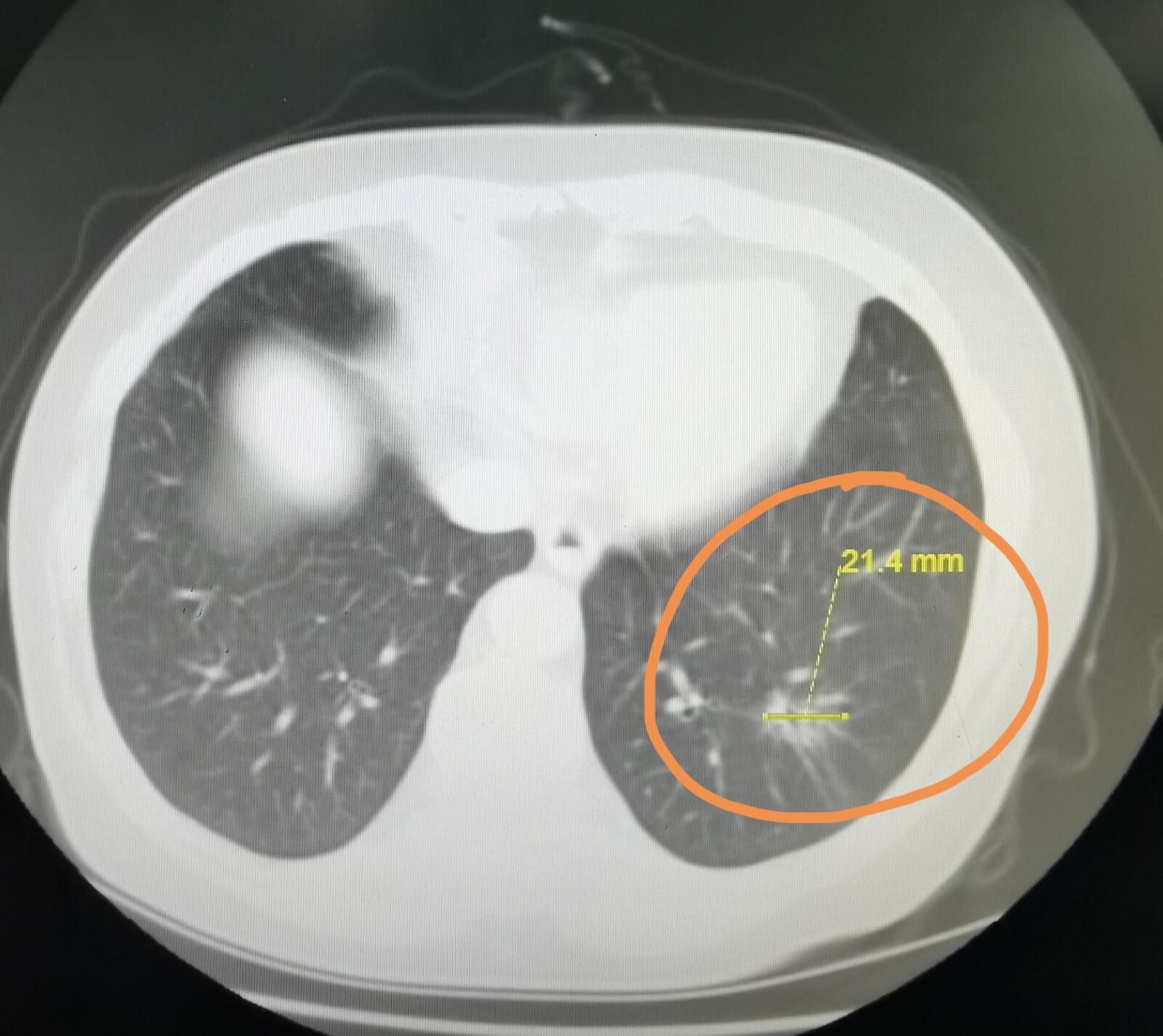 劉懿博士說肺癌三六二〇輸尿管惡性腫瘤住院發現肺磨玻璃結節