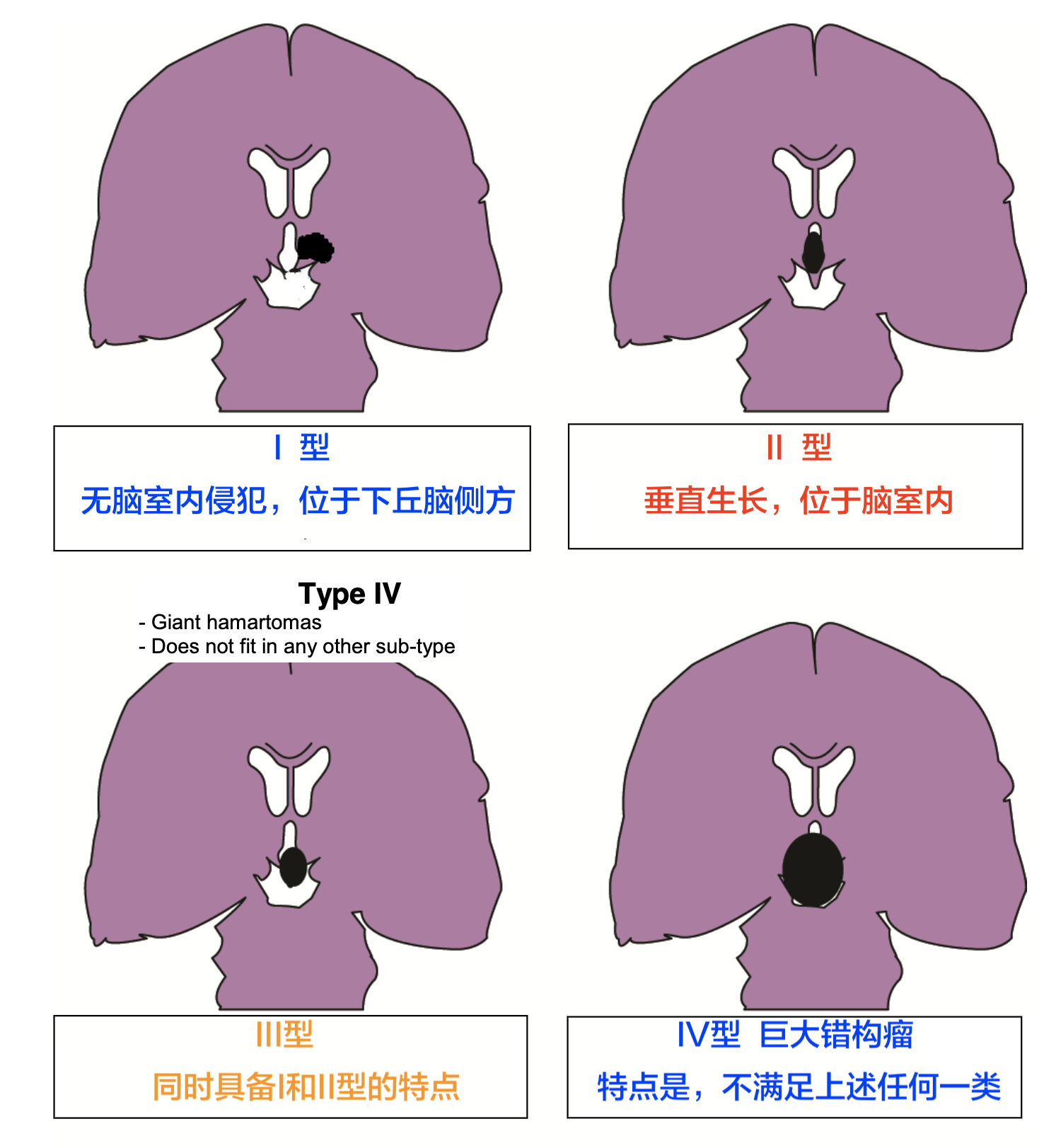 错构瘤下丘脑的分型.png