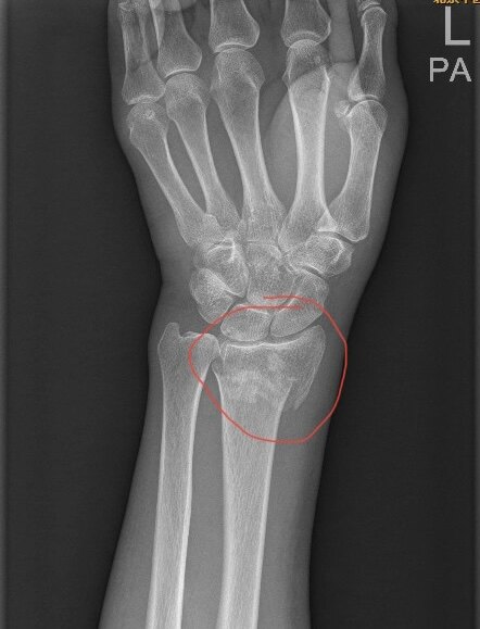 阿耀科普 一文读懂 桡骨远端骨折 桡骨下端骨折 好大夫在线 阿耀科普 一文读懂 桡骨远端骨折 桡骨下端骨折 好大夫在线