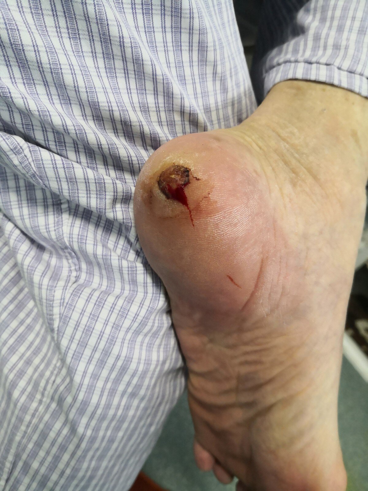 手术切除足部肿物 - 好大夫在线