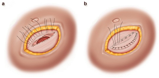 《hernia surgery》, chapter 19)2,成人臍疝的(手術)治療成人臍疝不