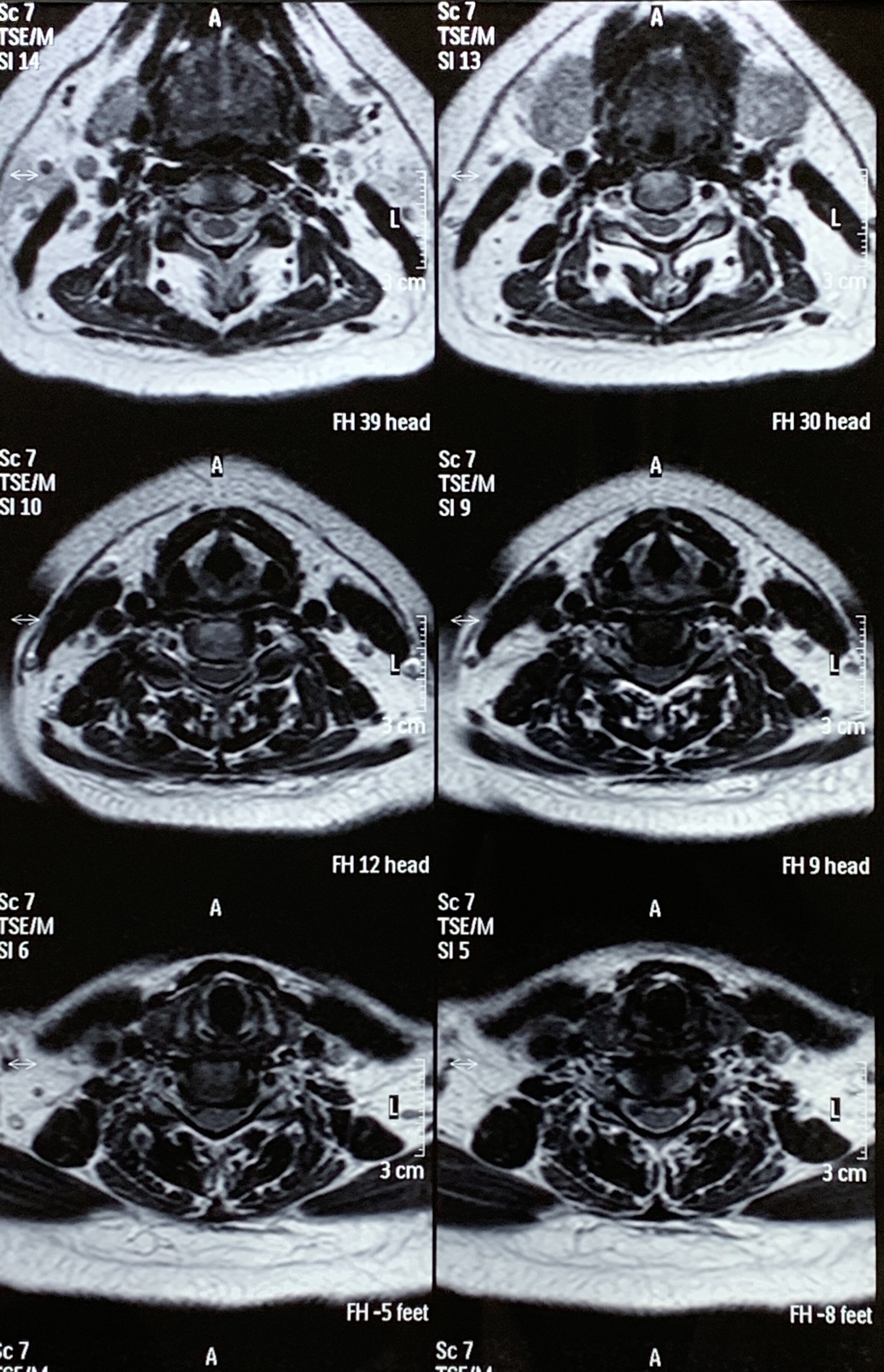 20220411平涼人民醫院頸椎mri13.jpg