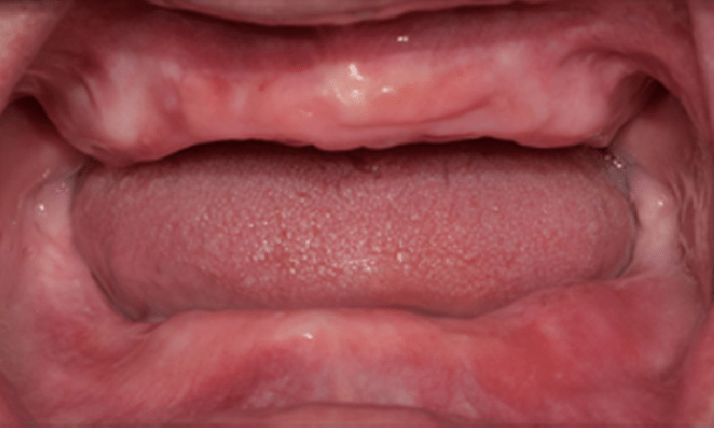 Frontal-view-of-fully-edentulous-mouth-of-the-patient-Fig-2-Class-II-jaw-relationship.png