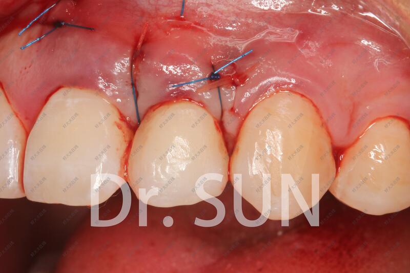 牙龈减张缝合图片