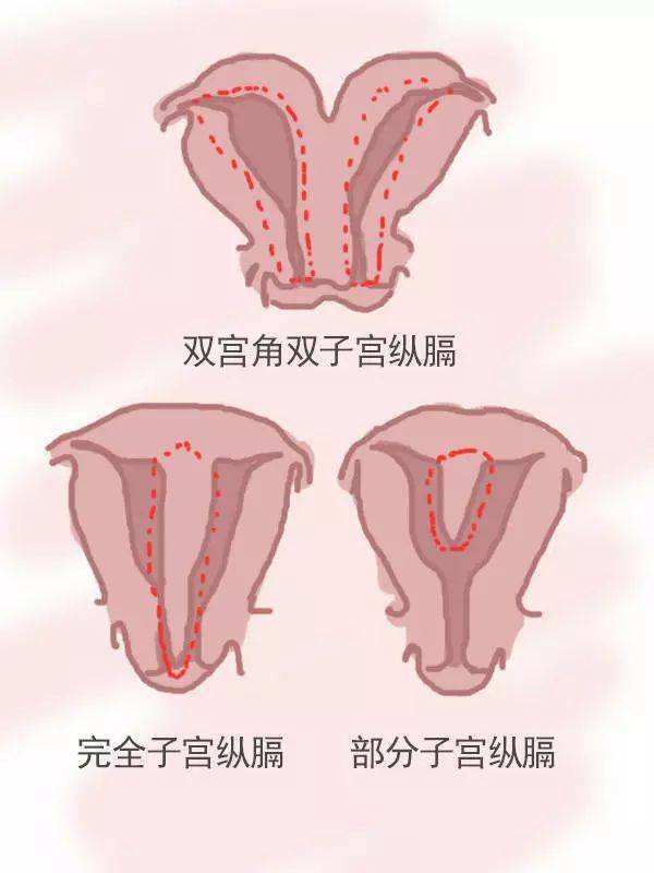 畸形子宫形态图片